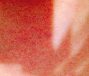 Lovely rash after this morning's shower. Decided a small photo was best. :-)